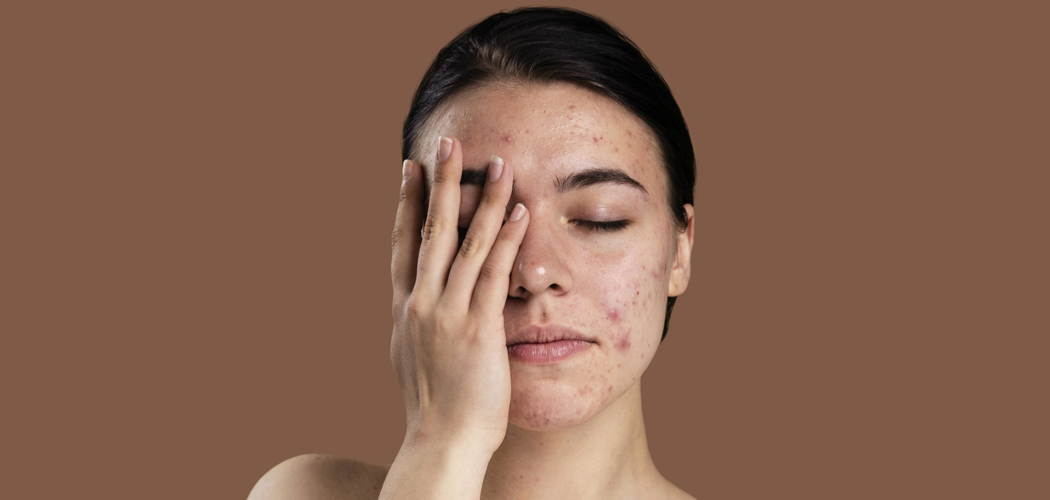 O que você come pode estar te causando acne