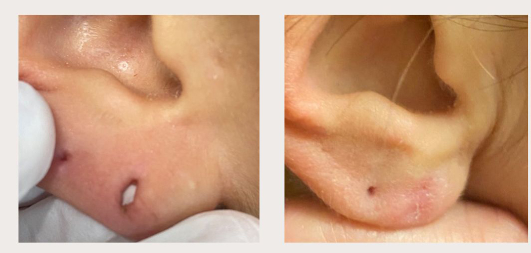Lobuloplastia sem cirurgia: entenda como funciona o procedimento