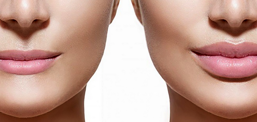 Especialistas tiram dúvidas sobre preenchimento labial