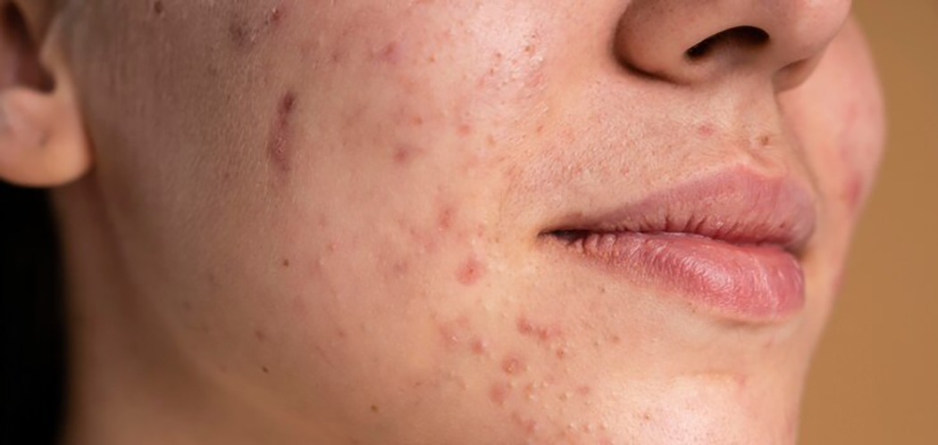 Mitos e verdades: Chocolate causa acne e espinhas?