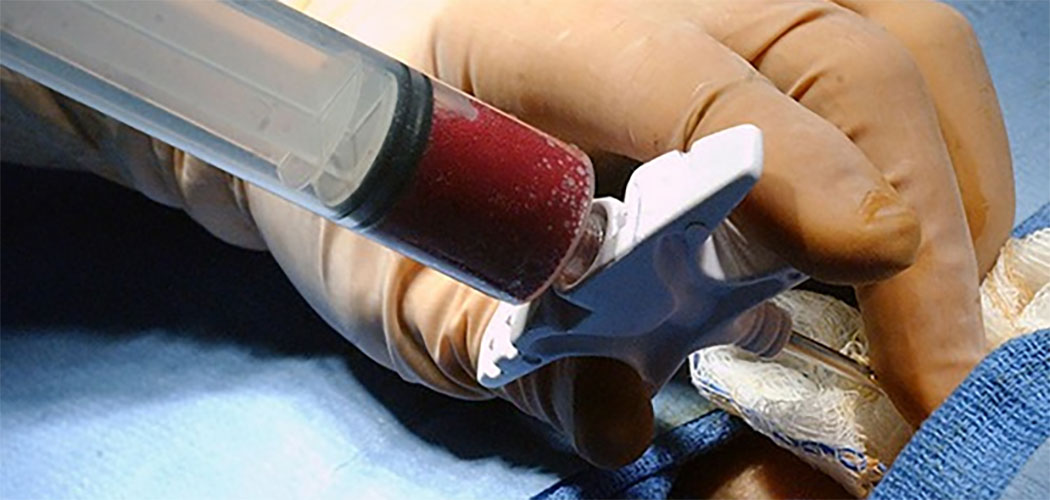 Doar medula óssea é simples e pode salvar muitas vidas