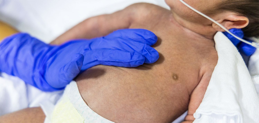 SC registra mais de dois mil casos de Síndrome Respiratória Aguda Grave em 2025