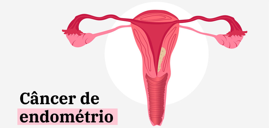 Câncer de endométrio exige atenção às mudanças hormonais nas mulheres