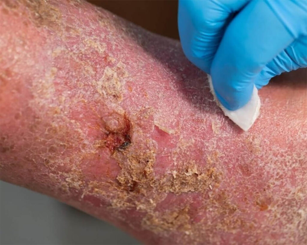 Diabetes e doenças vasculares 