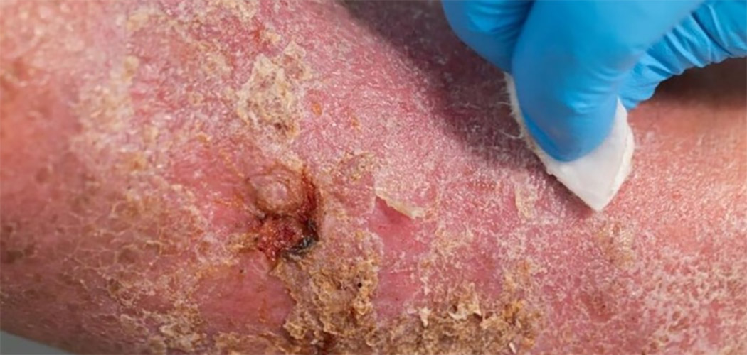 Diabetes e doenças vasculares