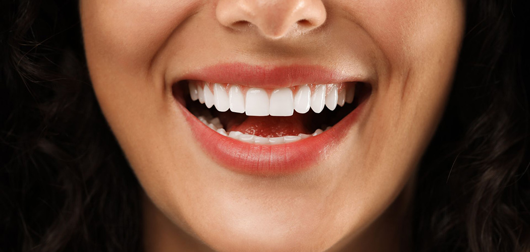 5 mitos e verdades sobre clareamento dental