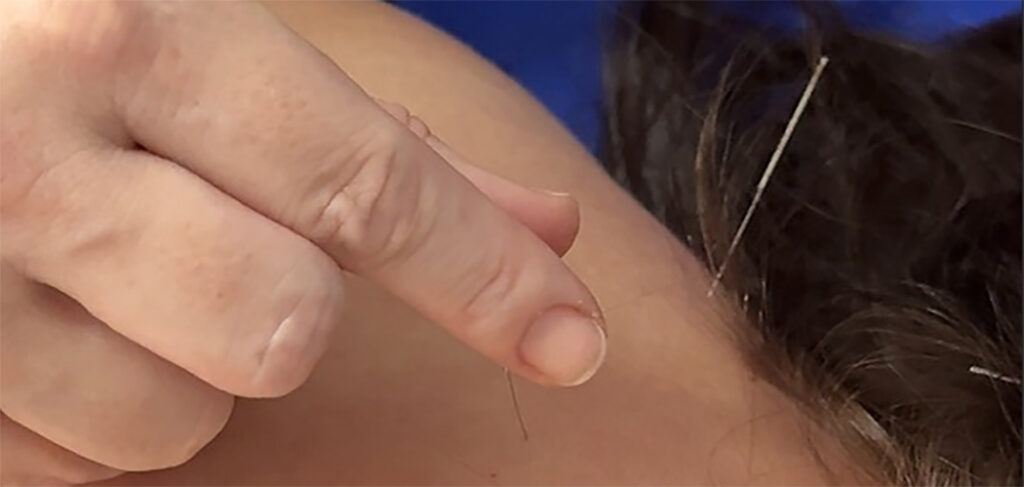 Acupuntura passa a ser oferecida nas unidades de saúde de Santa Helena e Nova Petrópolis em Joaçaba