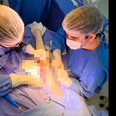 Cirurgias para o tratamento de lesões em nervos periféricos são realizadas no HUST Joaçaba