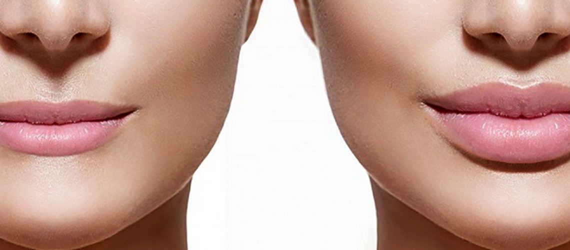 Especialistas tiram dúvidas sobre preenchimento labial