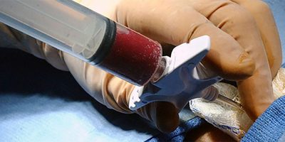 Doar medula óssea é simples e pode salvar muitas vidas